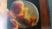 Im 4. Monat im Bauch der Mutter...
